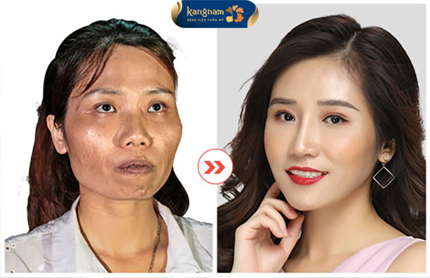 Khách hàng lột xác hoàn toàn sau khi thực hiện hạ gò má tại Kangnam