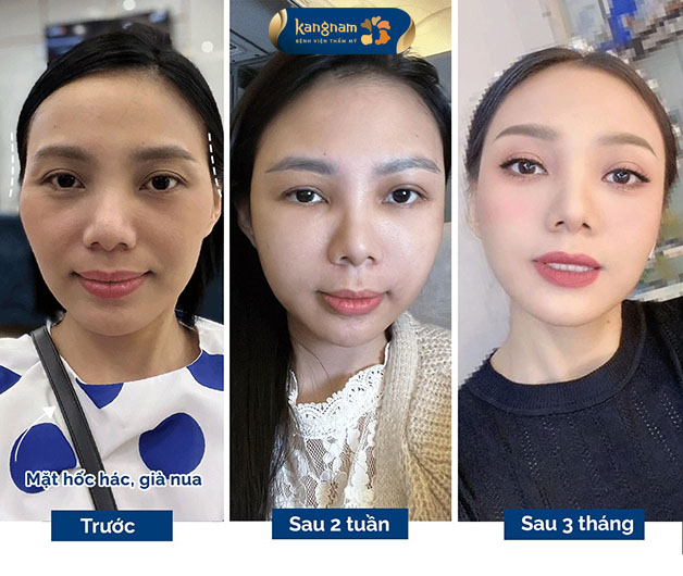 Vùng hóp ở thái dương đầy đặn khiến khuôn mặt khách hàng trẻ hơn nhiều 