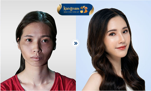 Hình ảnh khách hàng sau khi phẫu thuật