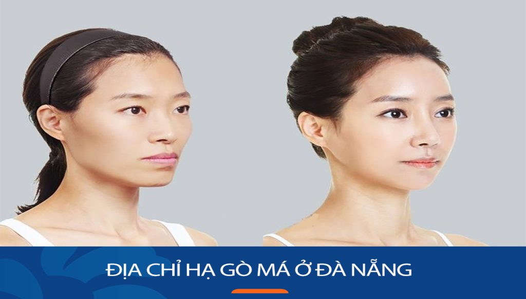 Hạ gò má kangnam Đà Nẵng
