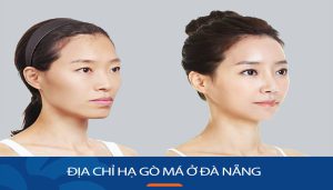 Hạ gò má kangnam Đà Nẵng
