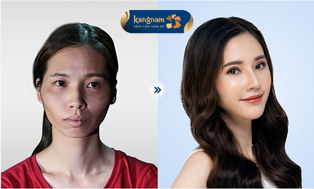 Tại Kangnam có đội ngũ bác sĩ chuyên môn, ứng dụng công nghệ hiện đại đã giúp nhiều khách hàng lột xác hoàn toàn