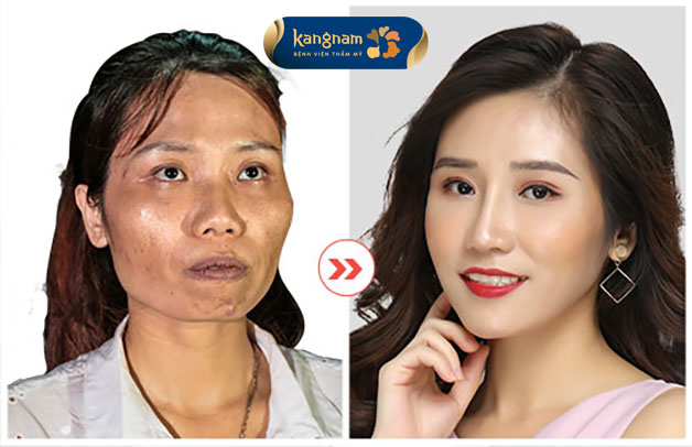 Nhan sắc thăng hạng sau khi thực hiện dịch vụ hạ gò má