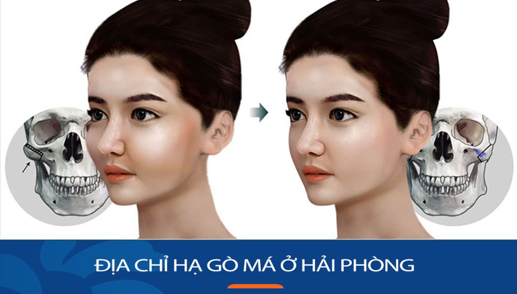 Hạ gò má kangnam Hải Phòng