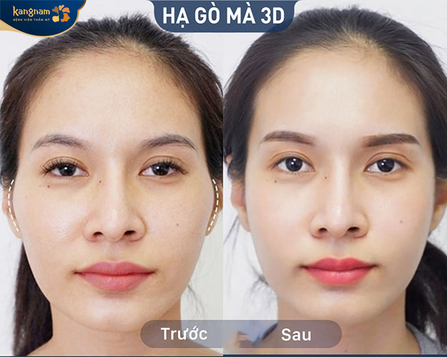 Công nghệ hạ gò má 3D