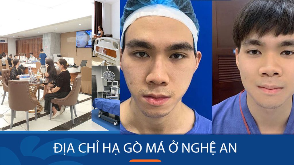 Hạ gò má Kangnam Nghệ An