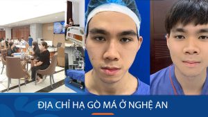 Hạ gò má Kangnam Nghệ An