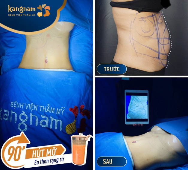 Công nghệ hút mỡ Vaser 6D