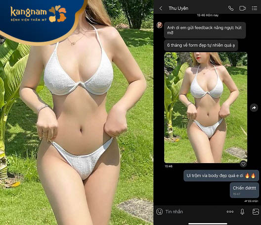 Bạn Thu Uyên feedback sau nâng ngực hết hợp hút mỡ bụng