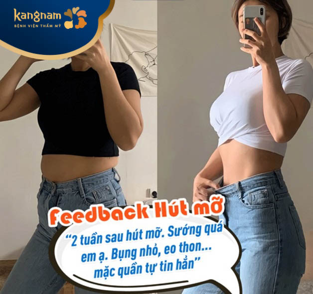 Bạn Hồng Linh feedback sau hút mỡ