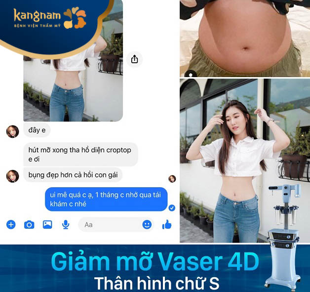 Chị Thu Thảo feedback sau khi hút mỡ Vaser 4D tại Kangnam