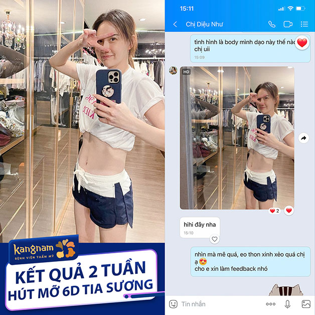 Vòng eo sau khi hút mỡ phẳng lì, không để lại sẹo xấu 