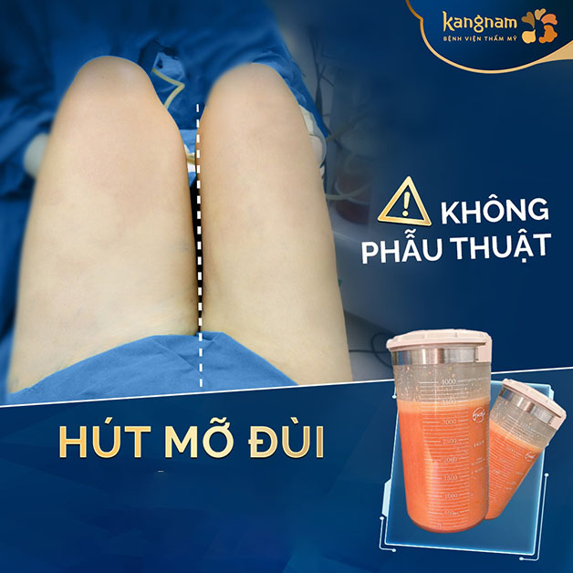 Sự khác biệt một rõ ràng sau khi hút mỡ đùi 