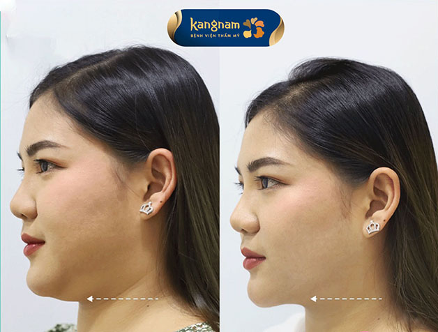 Hút mỡ nọng cằm 