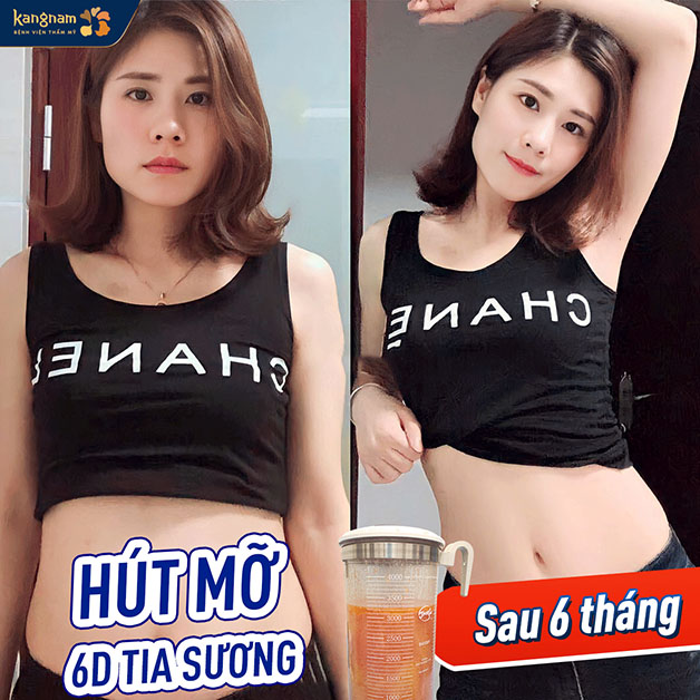 Công nghệ hút mỡ 6D tia sương