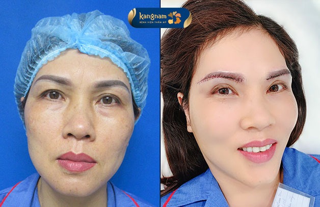 Chị Thảo Linh cảm thấy ưng ý khi cải thiện được chân mày