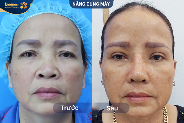 Cô Thu Hà chia sẻ cảm nghĩ sau nâng cung mày tại Kangnam