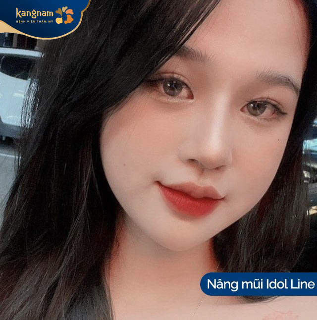 Bạn Thu Hoài thực hiện dịch vụ nâng mũi Idol Line