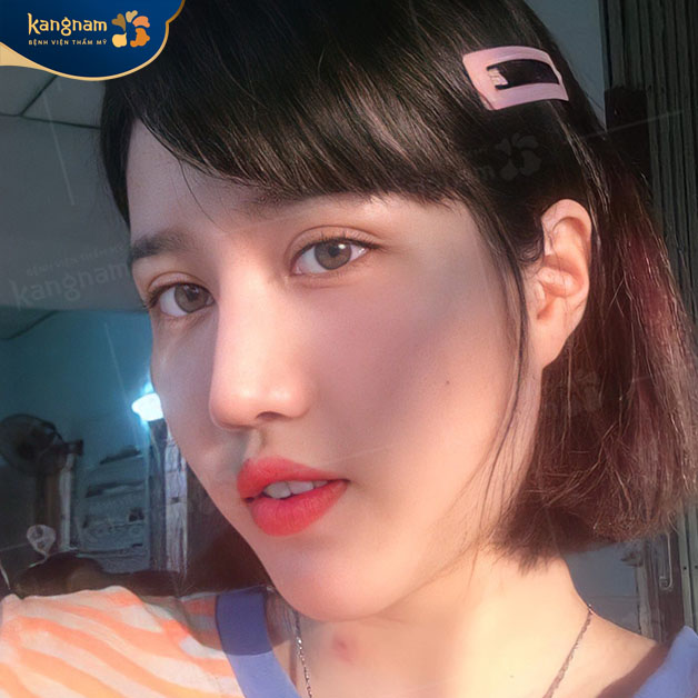 Kangnam là địa chỉ nâng mũi uy tín ở Cần Thơ