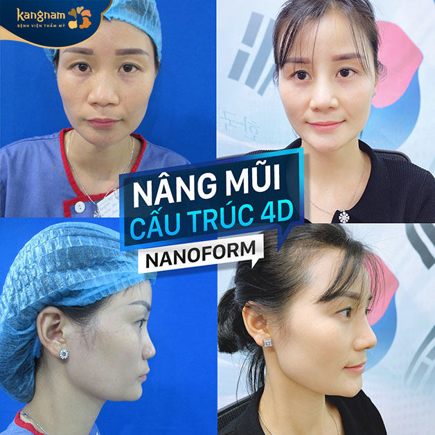 Gương mặt khách hàng thu hút hơn sau khi thực hiện nâng mũi cấu trúc 