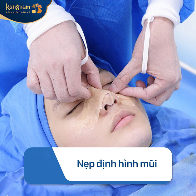 Mũi sẽ được nẹp cố định đến khi vào form 