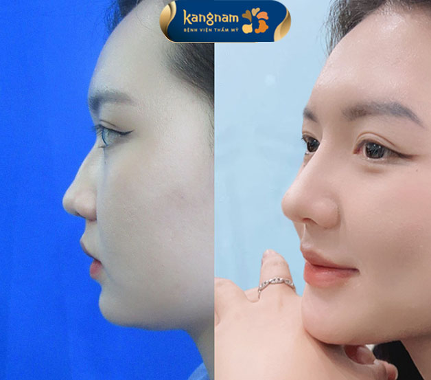 Nâng mũi sụn sườn được nhiều chị em chọn lựa 