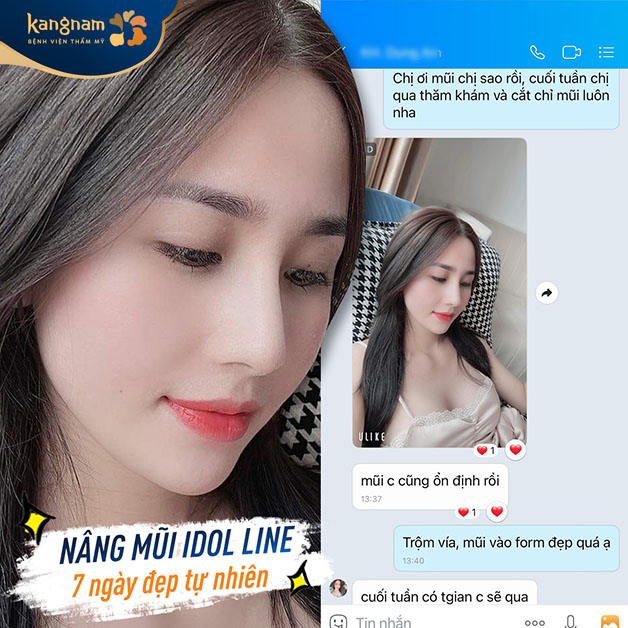Dáng mũi ổn định, hài hòa với khuôn mặt chỉ sau 7 ngày 