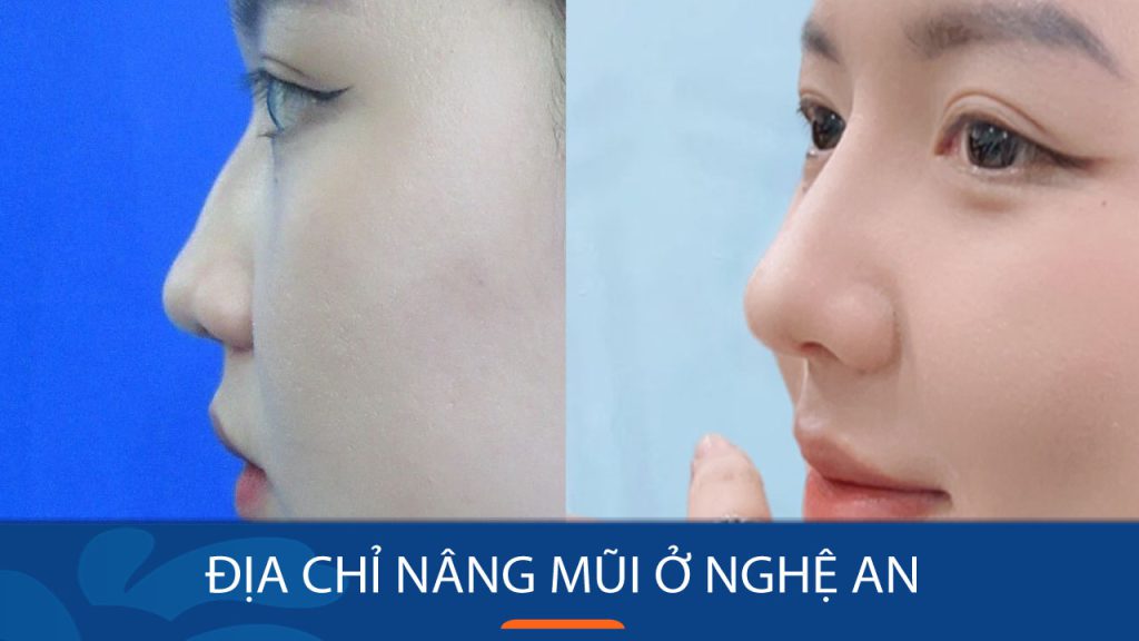 Địa chỉ nâng mũi kangnam Nghệ An uy tín, nâng mũi siêu nhẹ, bền đẹp