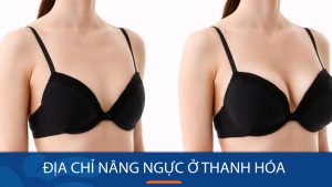 Địa chỉ nâng ngực kangnam Thanh Hóa an toàn, bền đẹp tự nhiên