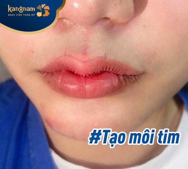 Tạo hình môi tim chuẩn Hàn 3D