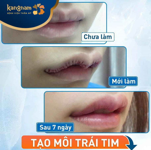 Tạo hình môi tim 6D