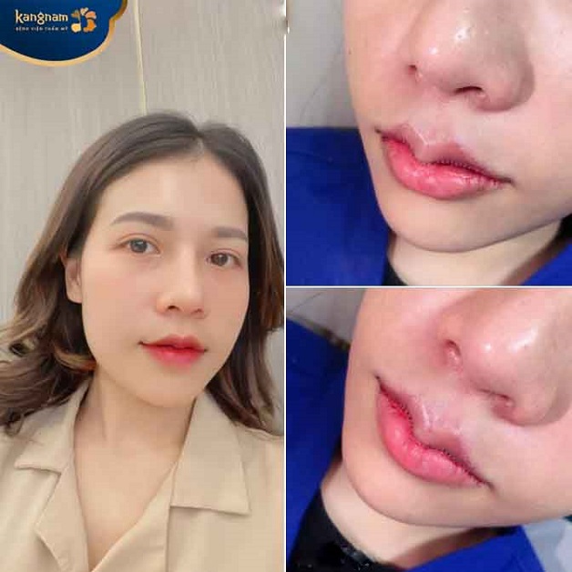 Khách hàng Tú Linh chia sẻ sau 1 ngày làm môi