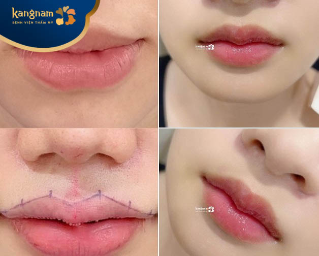 Chị Trúc Linh feedback sau tạo hình môi tại Viện thẩm mỹ Kangnam