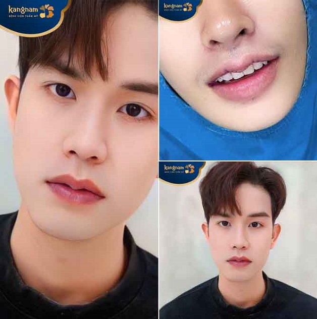 Bạn Hoàng Anh feedback sau phẫu thuật tạo hình môi 6D cho nam giới ở Kangnam