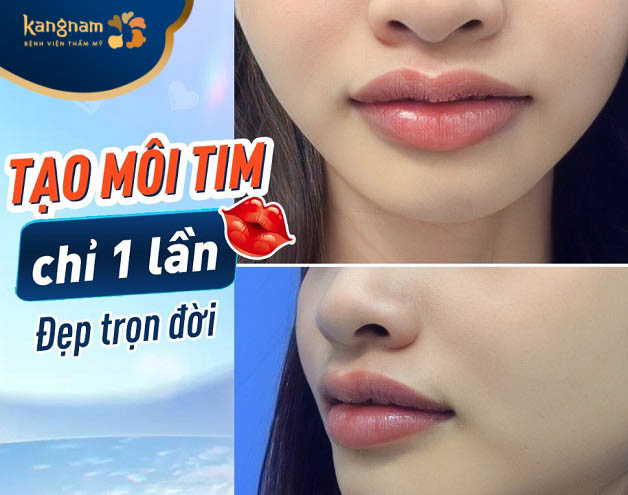 Địa chỉ tạo hình môi tim uy tín Hải Phòng 