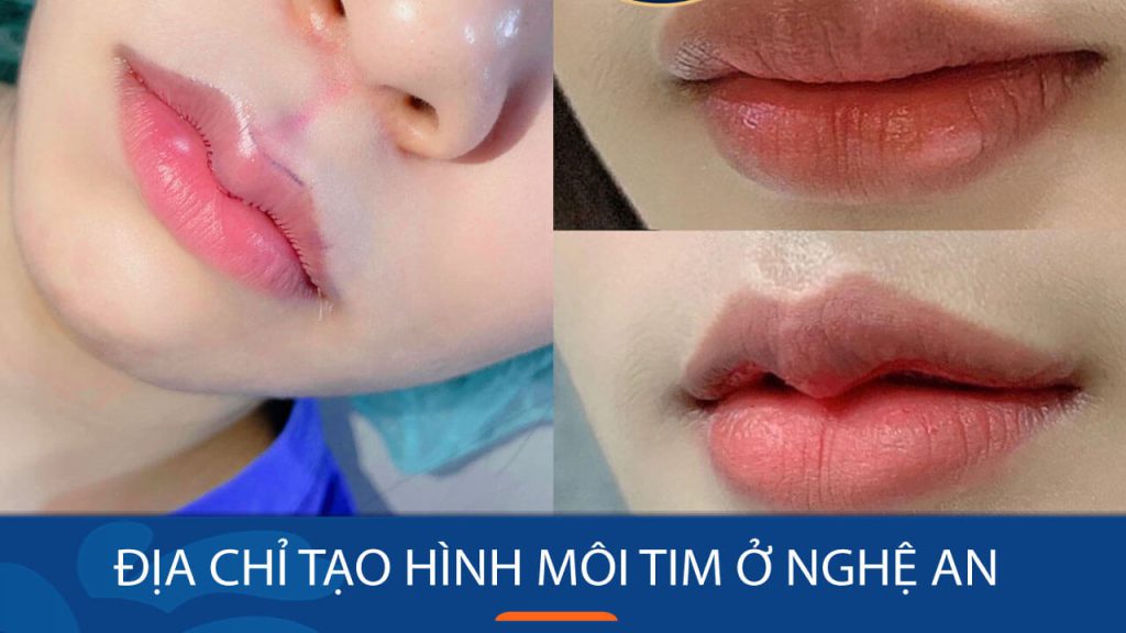 Địa chỉ tạo hình môi tim ở Nghệ An – Viện thẩm mỹ Kangnam
