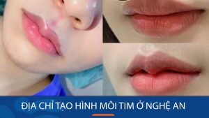 Địa chỉ tạo hình môi tim ở Nghệ An – Viện thẩm mỹ Kangnam