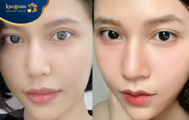 Dáng môi tim cười là sự lựa chọn hàng đầu của khách hàng