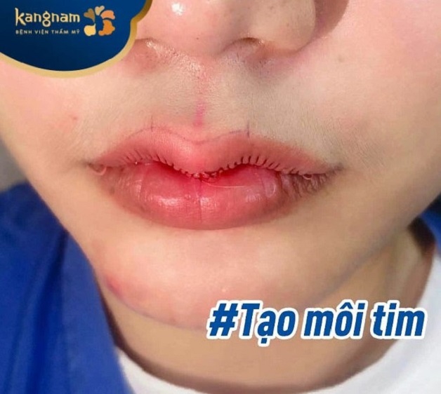 Tạo hình môi tim 3D chuẩn Hàn Quốc