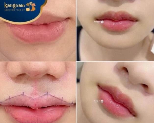 Môi của bạn Huỳnh Tú sau tạo hình môi tim