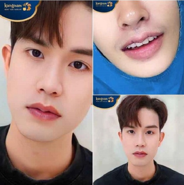 Bạn Tuấn Anh hài lòng với dáng môi đẹp, nam tính