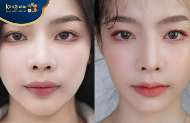 Tú Khuyên chia sẻ về kết quả sau làm môi tại Kangnam