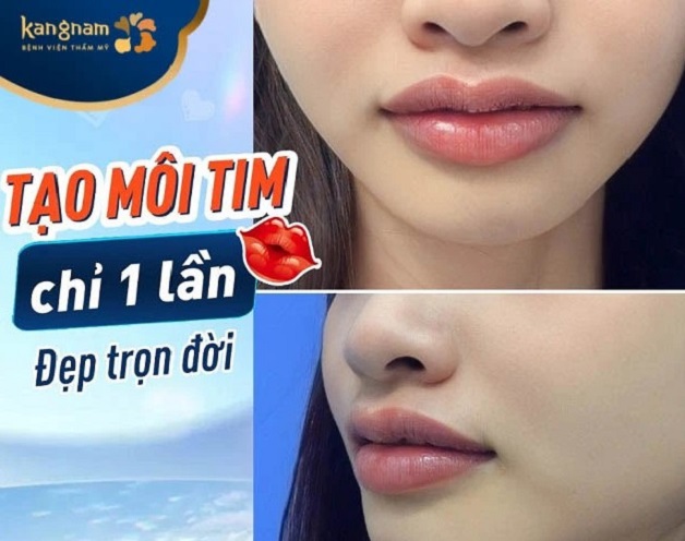 Dịch vụ tạo hình môi tim tại Kangnam Thanh Hóa