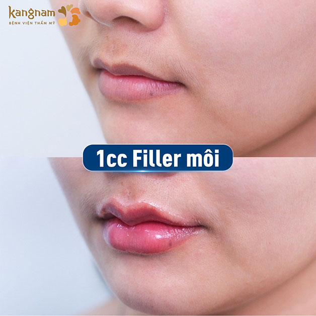Đôi môi đầy đặn, căng mọng sau khi tiêm filler 