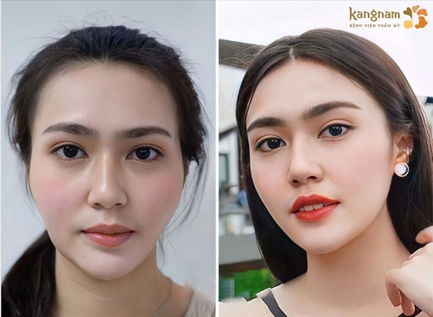 Tiêm filler làm đầy má và thái dương