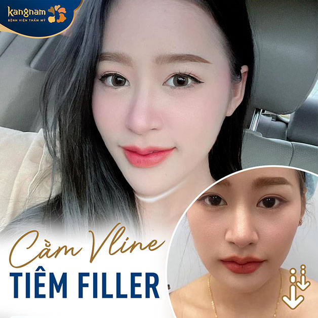 Tiêm filler sở hữu cằm Vline đúng mong muốn 