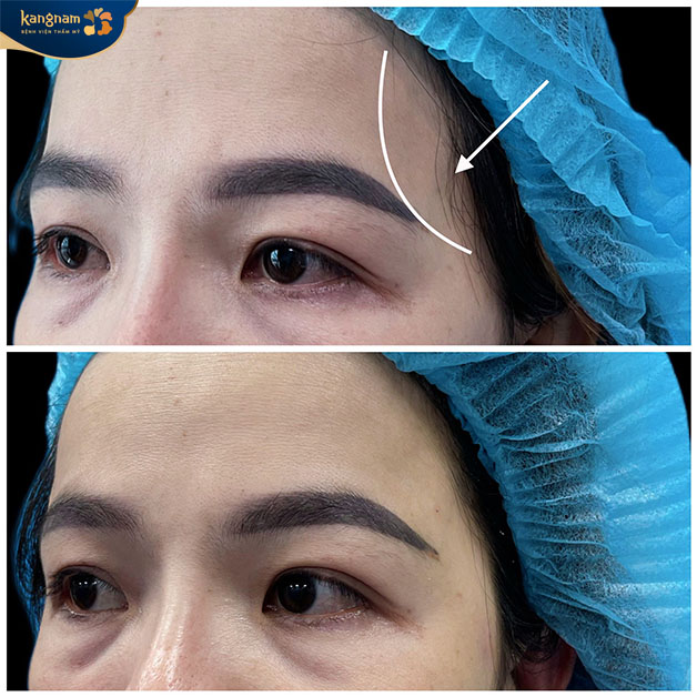 Tiêm filler làm đầy thái dương hóp 