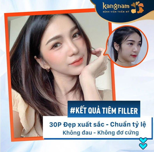 Tiêm filler mũi giúp cảo thiện hình dáng mũi 