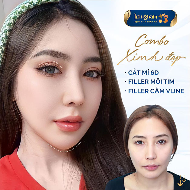 Khách hàng như trẻ ra 10 tuổi sau khi tiêm filler cằm và môi 