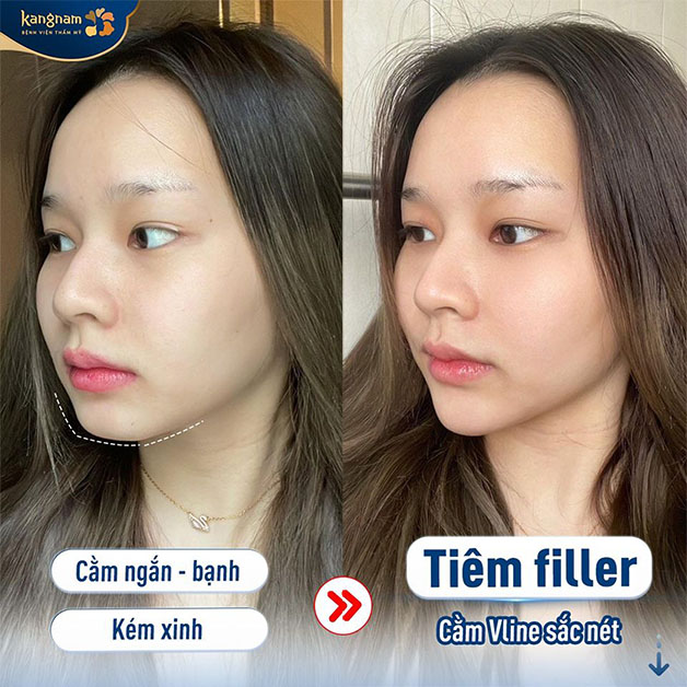 Hình ảnh khách hàng sau khi tiêm filler tại Kangnam 
